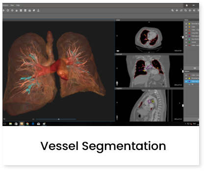 Vessel Segmentation