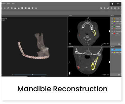 Mandible Reconstruction