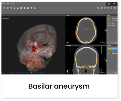 Basilar Aneurysm