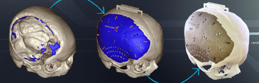 3D printed Patient specific Implants in India