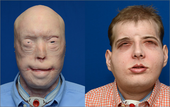Facial prosthesis