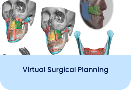 Virtual Surgical Planning