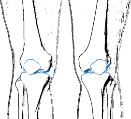 Patella